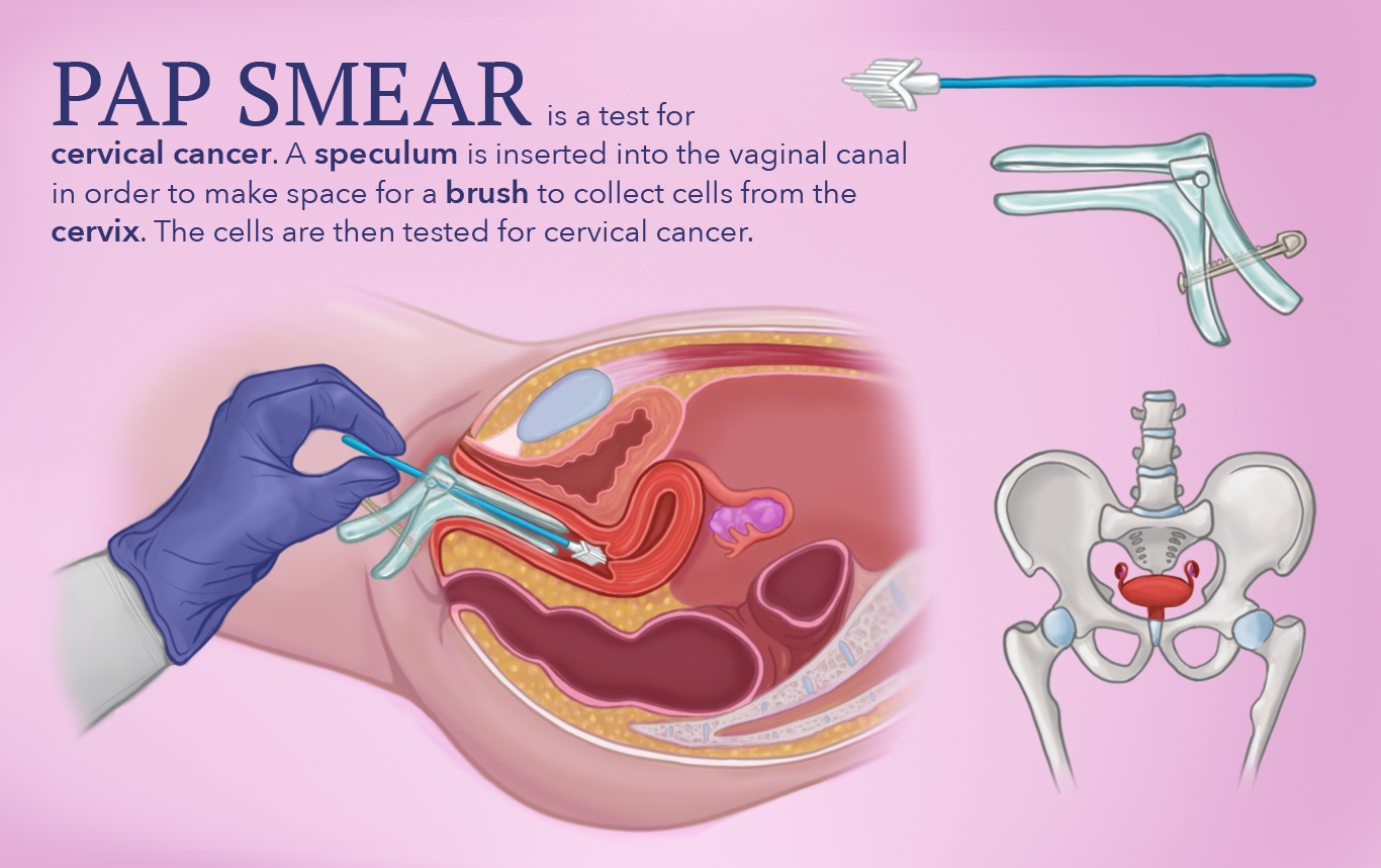 papsmear-illustration